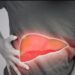 fatty liver